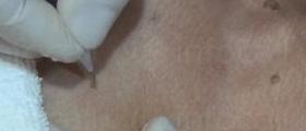 Електрокоагулация в Добрич - Доктор Вяра Ангелова Електрокоагулация в Добрич - Доктор Вяра Ангелова