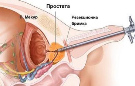 Цистоскопия в град Благоевград - Уролог Благоевград Цистоскопия в град Благоевград - Уролог Благоевград